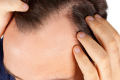 Neuer Schönheitstrend: Haartransplantationen
Bild: © Antonio Gravante - Fotolia.com